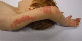 Herpes zoster, or shingles, is a viral disease that produces a painful skin rash and blisters.