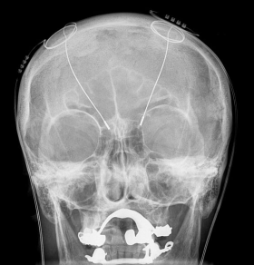 Deep brain stimulation for the treatment of Parkinson's diesease.