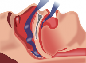 Sleep apnea is fundamentally cause by an airway restriction that prevents a person from falling completely asleep.