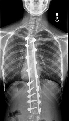 A spine corrected with the traditional, fixed method to correct scoliosis
